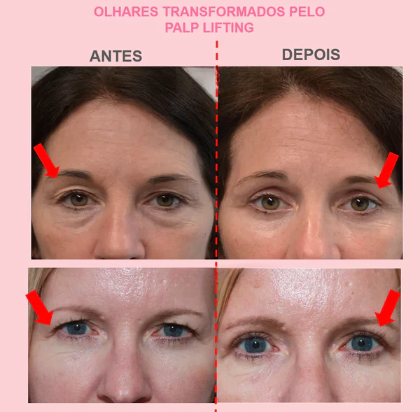 Adesivo-para-Pálpebras-Caídas-Cherry-Modas